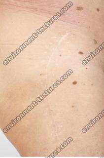 human skin scar 0001